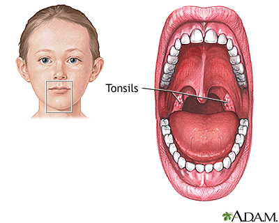 Tonsillectomy - Series