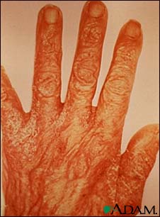 Scabies rash and excoriation on the hand