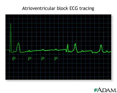 Atrioventricular block - ECG tracing