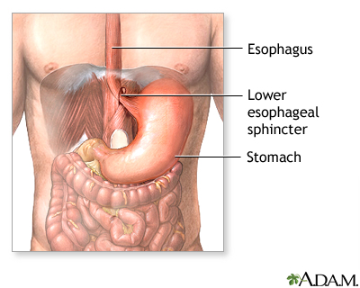 Gastroesophageal reflux - series