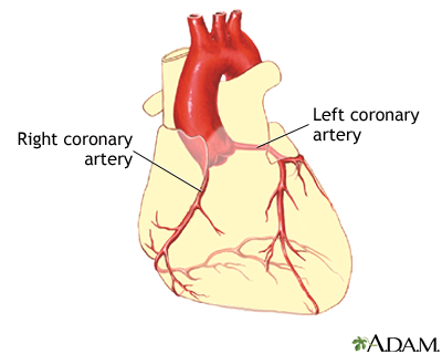 Coronary artery balloon angioplasty - Series