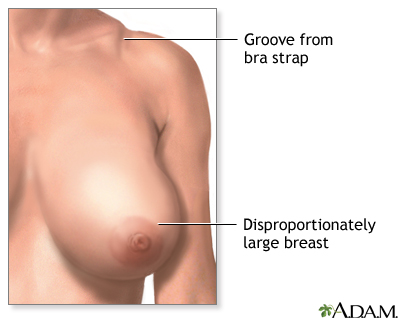 Breast reduction (mammoplasty) - series - Indications