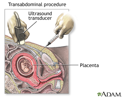Procedure, part 2 - transabdominal