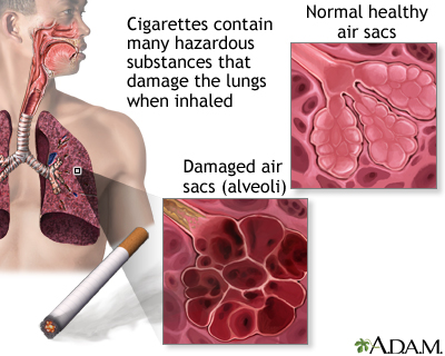 Smoking and COPD (chronic obstructive pulmonary disorder)
