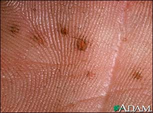 Basal cell nevus syndrome - close-up of palm