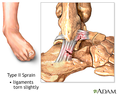 Type II ankle sprain