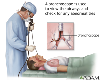¿Qué es la broncoscopia?