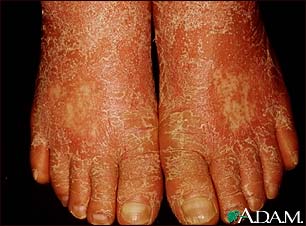 Pityriasis rubra pilaris on the feet