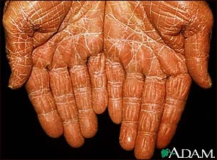 Pityriasis rubra pilaris on the palms
