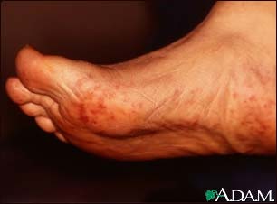 Cholesterol emboli Livedo Reticularis - feet