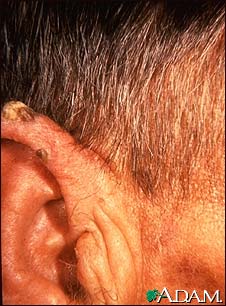 Actinic keratosis - ear