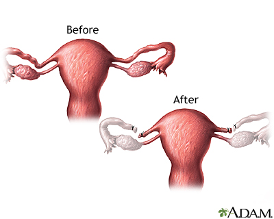Before and after tubal ligation