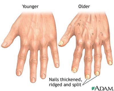 Aging changes in nails