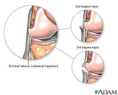 Lateral collateral ligament injury
