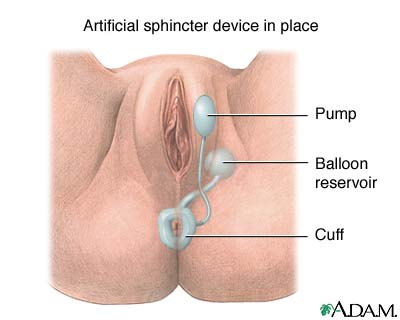 sphincter indiana artificial anal Inflatable