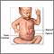 Infantile pyloric stenosis - series