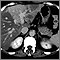 Liver with disproportional fattening - CT scan