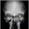Neurofibromatosis I - enlarged optic foramen