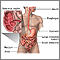 Crohn disease - affected areas