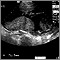 Ultrasound, normal placenta - Braxton Hicks