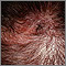 Ringworm, tinea capitis - close-up