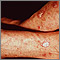 Actinic keratosis on the forearms
