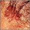 Skin cancer, basal cell carcinoma - pigmented