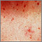 Urticaria pigmentosa - close-up
