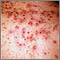 Acne - close-up of cysts on the back