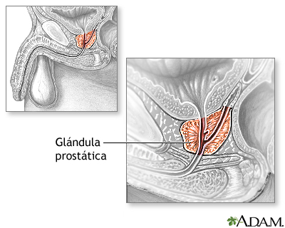 Resección transuretral de la próstata (RTUP) - Serie