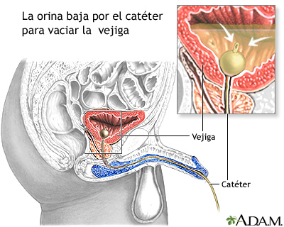 Cateterismo vesical en el hombre