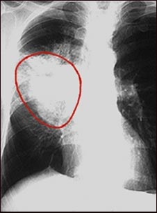 Cáncer de pulmón - radiografía frontal del tórax