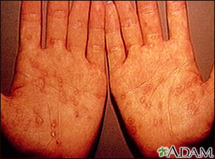 Sífilis - secundaria en las palmas de las manos