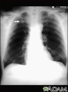Nódulo pulmonary - vista frontal en placa de rayos x de tórax