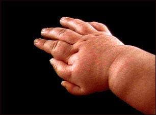 Polydactyly - an infant's hand