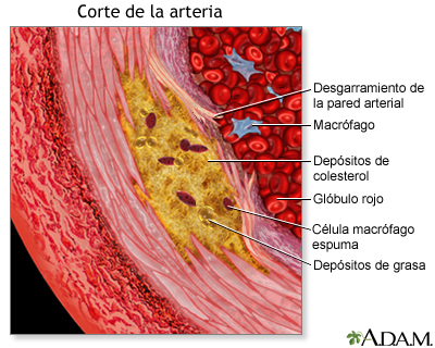 Vista agrandada de la aterosclerosis