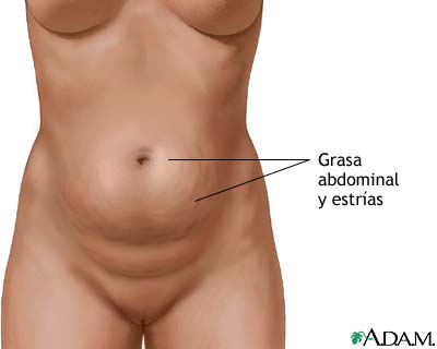 Abdominoplastia - serie