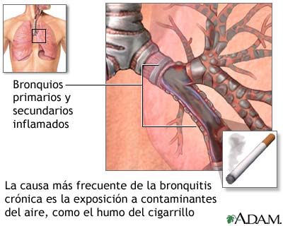 Causas de la bronquitis crónica