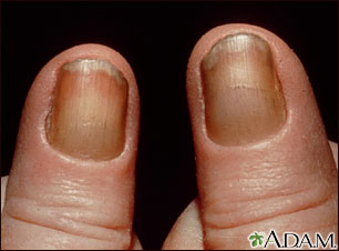 Síndrome de las uñas amarillas