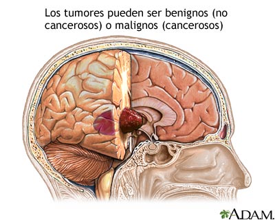 Tumor cerebral