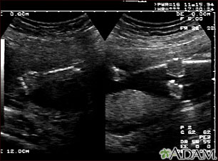 Ultrasonido, normal - brazos y piernas del feto