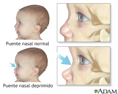 Puente nasal deprimido Puente nasal deprimido