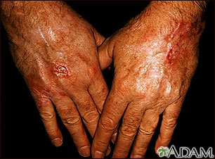 Cáncer de piel - escamocelular en las manos