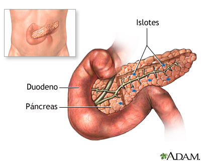 Trasplante de páncreas - serie Trasplante de páncreas - serie