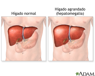 Hepatomegalia Hepatomegalia