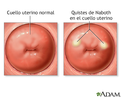 Quistes de Naboth Quistes de Naboth