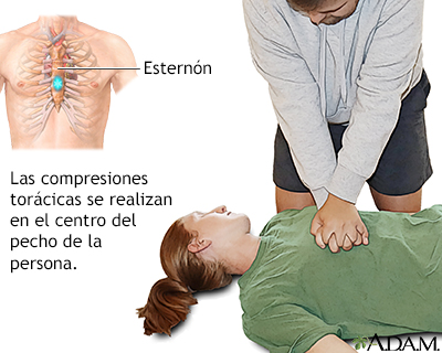La persona pierde el conocimiento La persona pierde el conocimiento