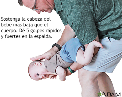El bebé se está asfixiando - dé golpes en la espalda El bebé se está asfixiando - dé golpes en la espalda