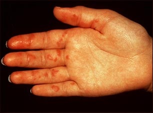 Vasculitis en la palma de la mano