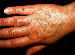 Vasculitis - urticarial en la mano